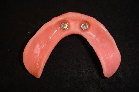 Overdenture inferior após captura dos attachments magnéticos com Dentusoft.