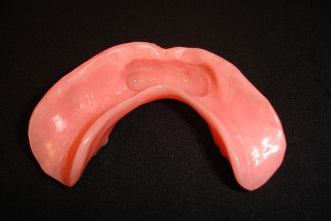 Prótese total inferior imediata com janela para captura dos attachments magnéticos que ficarão nesta região.