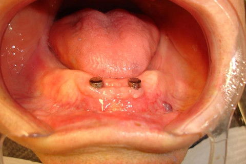 Já após cicatrização , os abutments magnéticos instalados sobre os implantes.
