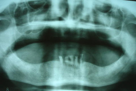 RX Panorâmico para exodontias e instalação de implantes imediatos na região entre os forames mentuais.