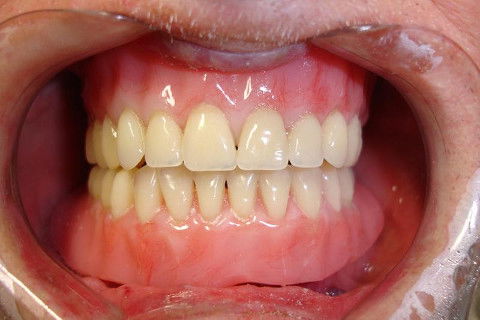 Instalação final das próteses.