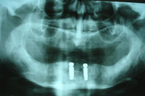 Após exodontia, instalação dos implantes imediatos e abutments magnéticos. Cirurgia realizada por Dr. Angelo Menuci Neto.