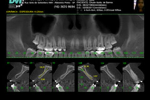 Foto inicial - Na tomografia voi verificado pouca disponibilidade óssea em espessura (2,9mm) e também espaço reduzido mesio-distal.