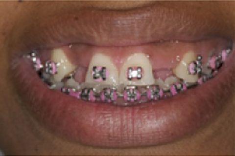 Decidimos instalar 02 implantes Xive 3,0 referente aos dentes 12 e 22.