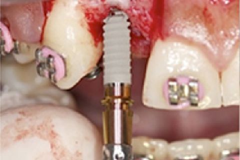 Cirurgia de instalação de implantes