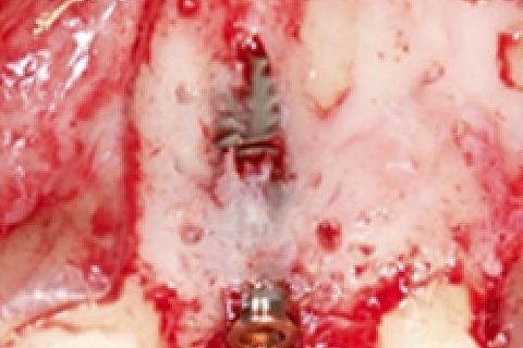 Implante instalado mostrando fenestração vestibular que foi corrigida com enxerto ósseo e membrana. (Bio oss e Bio guide - seguindo protocolo de Buser.