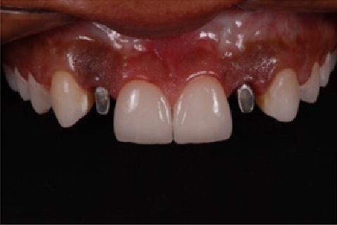 Instalação dos pilares