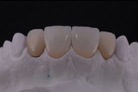 Microlaminados Cerâmicos e Implantes Estreitos – Reabilitação Estética em Agenesia de Incisivos Laterais