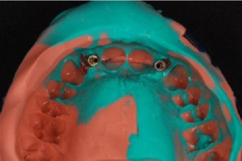 Microlaminados Cerâmicos e Implantes Estreitos – Reabilitação Estética em Agenesia de Incisivos Laterais