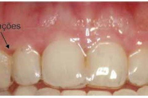 Alinhador em boca exemplificando as ativações e regiões de alívio