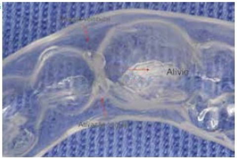 Ativações feitas em forma de bolhas internas na interproximal por vestibular e lingual