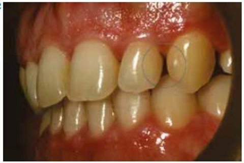 Espaço na distal do lateral após 15 dias de uso do alinhador