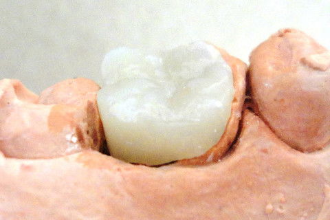 Restauração em Resina Composta (ONLAY) Realizada no Consultório