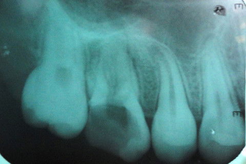 Aspecto Radiográfico Inicial