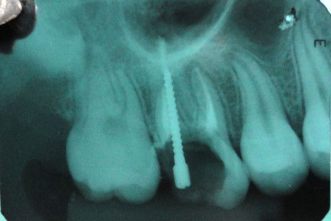 Cimentação de Pino Metálico Pré- Fabricado