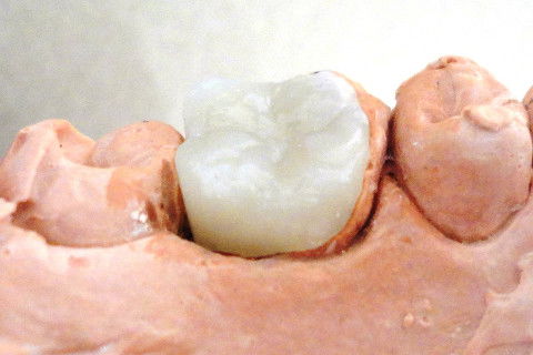 Restauração em Resina Composta (ONLAY) Realizada no Consultório