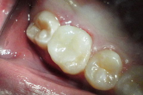 Aspecto Clínico Final, após cimentação da peça, acabamento e polimento.