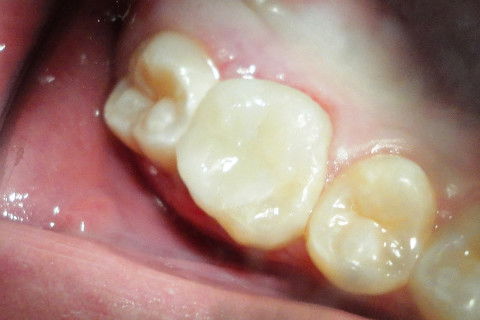 Aspecto Clínico Final, após cimentação da peça, acabamento e polimento.