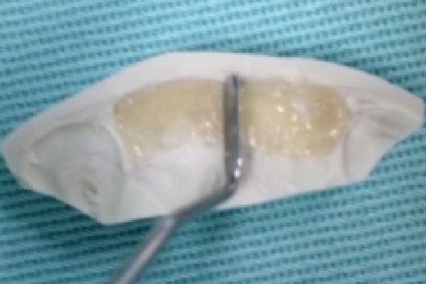 Preenchimento da guia palatina