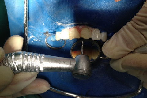 Remoção da resina da restauração antiga.