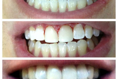 Fase inicial do paciente - facetas sem polimento e ajuste oclusal - resultado final das facetas com polimento e ajuste oclusal.