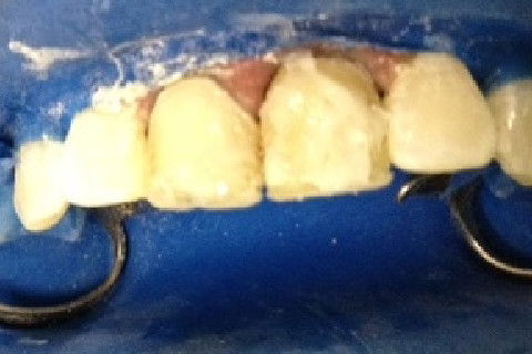 Guia palatina posicionada e fotopolimerizada, e inicio da confecção das facetas.