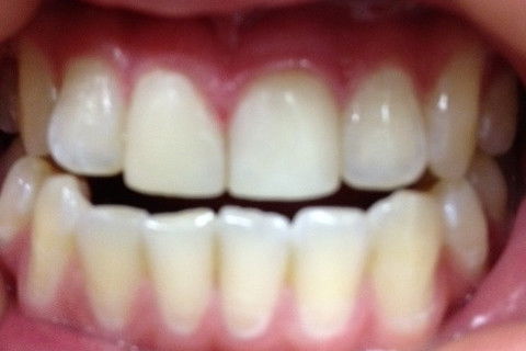 Resultado final com polimento e com ajuste oclusal.