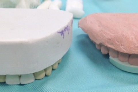 Molde de alginato com a prévia do protético, novo molde de gesso e guia palatina.