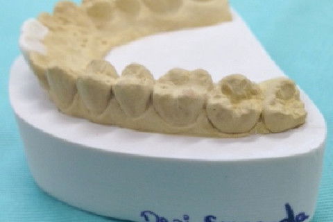 Molde de alginato e prévia do protético