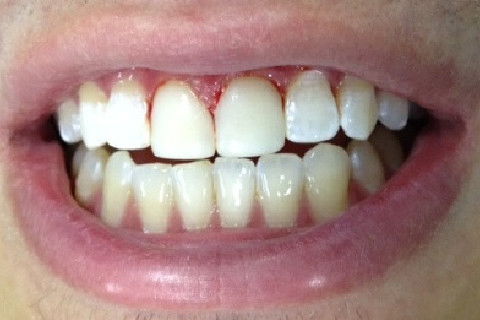 Resultado inicial sem polimento e sem ajuste oclusal.