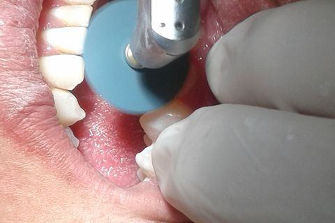 Polimento com discos abrasivos Sof-lex