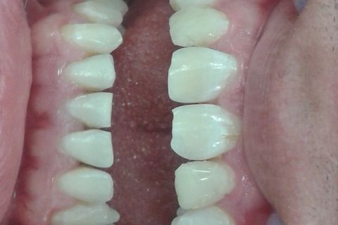 Restauração de Dente Conóide.