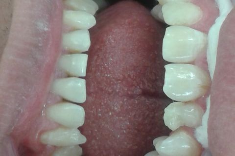 Restauração de Dente Conóide.