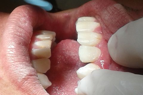 Restauração de Dente Conóide.