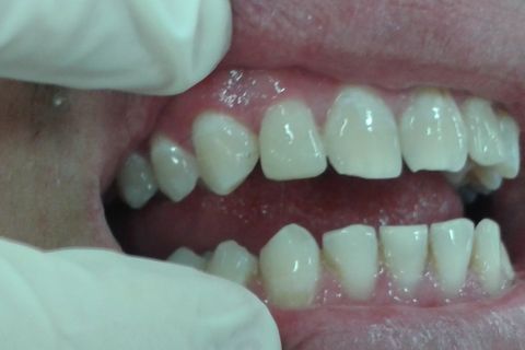 Restauração de Dente Conóide.