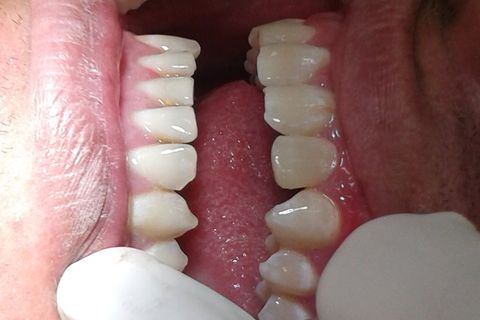 Restauração de Dente Conóide.