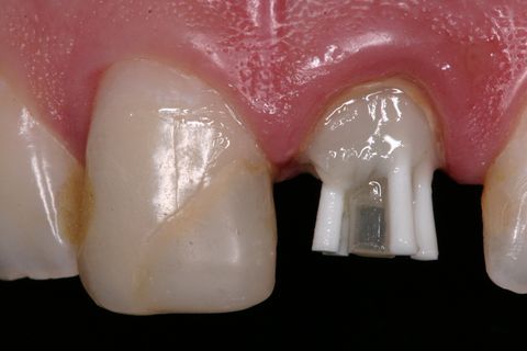 Aplicação do adesivo na porção coronária