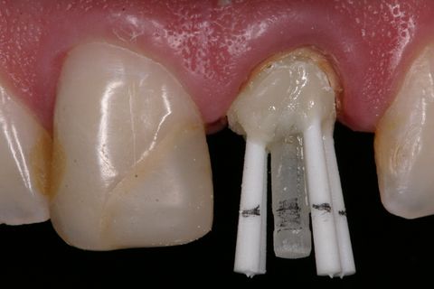 Marcação dos pinos para posterior recorte