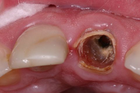 Aspecto clínico inicial (vista oclusal)