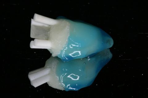 Condicionamento ácido do pino anatômico por 30 segundos