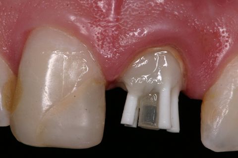 Aspecto clínico após cimentação (tempo de 5 min)