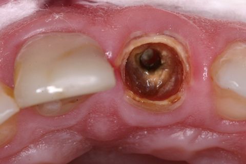 Aplicação de primer e adesivo no remanescente dentário (sistema Fusion Duralink - Angelus, brasil)