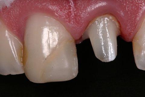 Preparo protético do núcleo