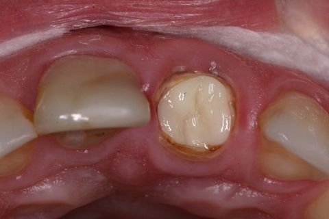 Inserção da resina no remanescente dentário