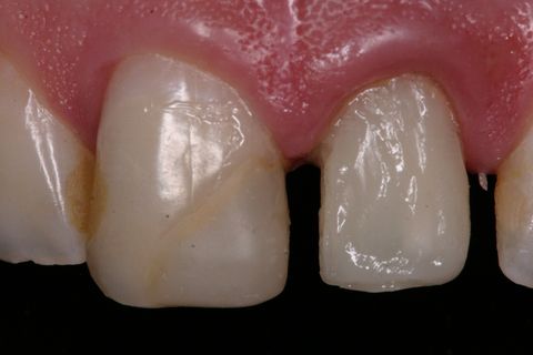 Inserção de resina composta em porções incrementais para confecção do núcleo