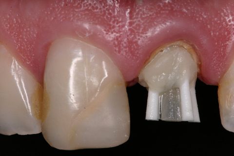 Verificação da adaptação do pino anatômico no remanescente dentário