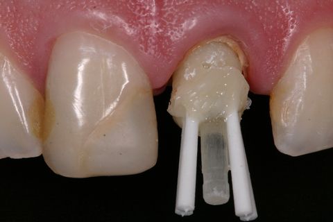 Reconstrução da porção coronária com mesma resina composta utilizada no conduto