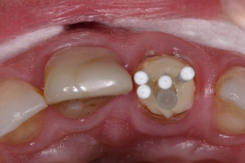 Inserção dos pinos acessórios na resina