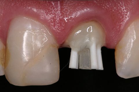 Cimentação do pino com cmento resinoso autopolimerizável