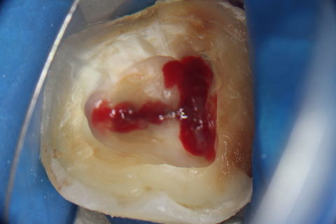 Acesso à câmera pulpar e localização dos canais